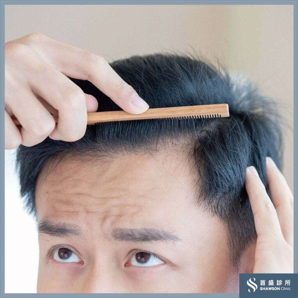 M型禿有救嗎 3種治療方式介紹 替你守住最後一道防線 首盛診所