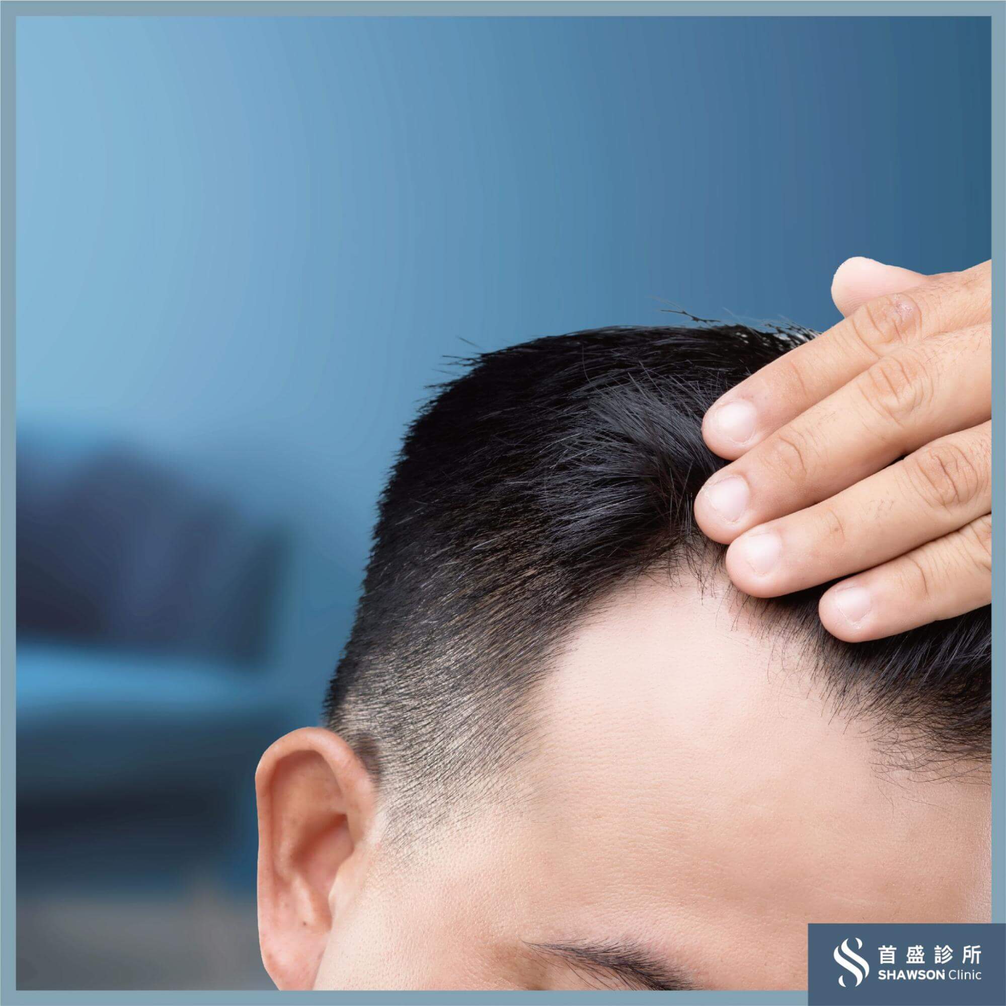 雄性禿原因解密 一篇瞭解成因與治療方式 擺脫頂上無毛窘境