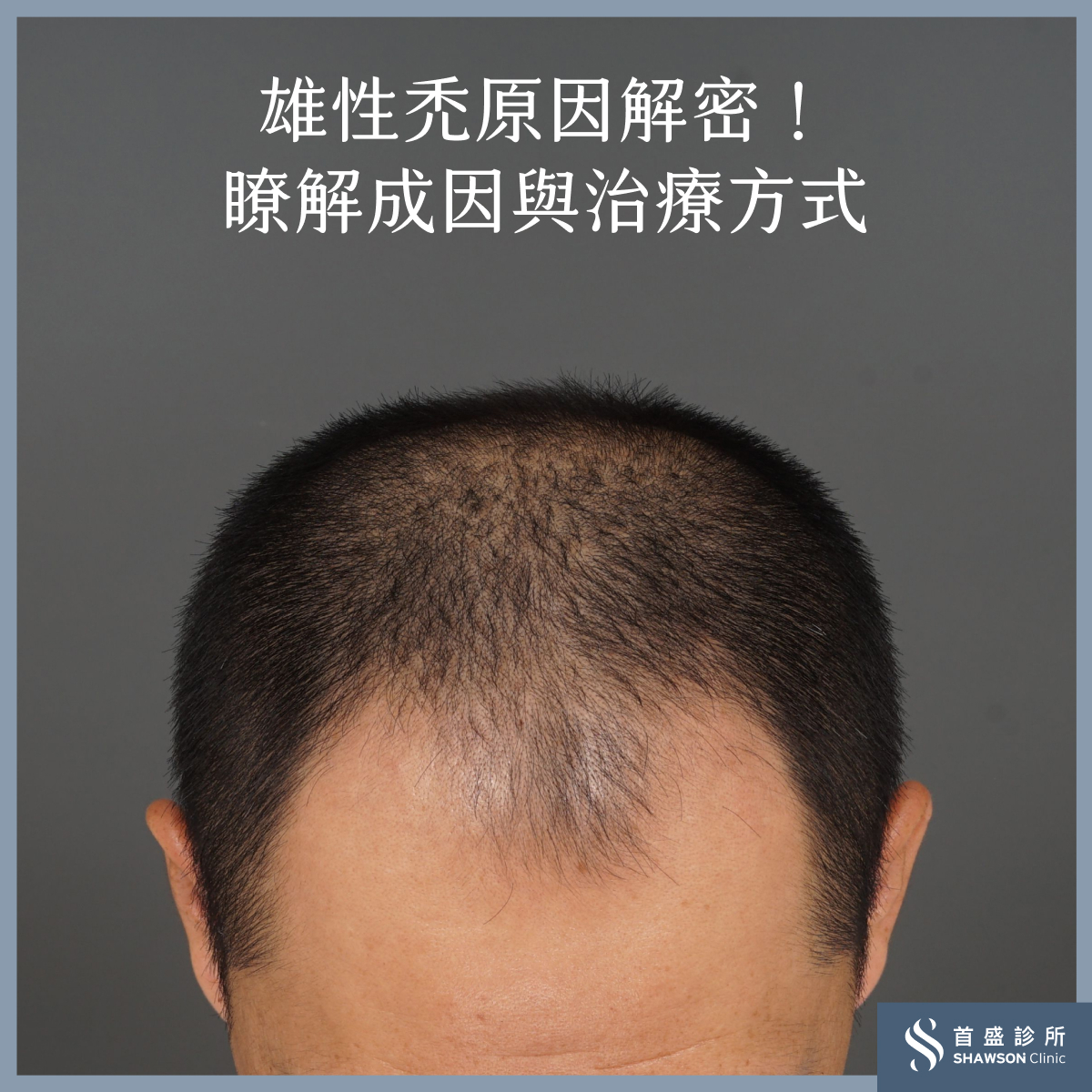 雄性禿原因