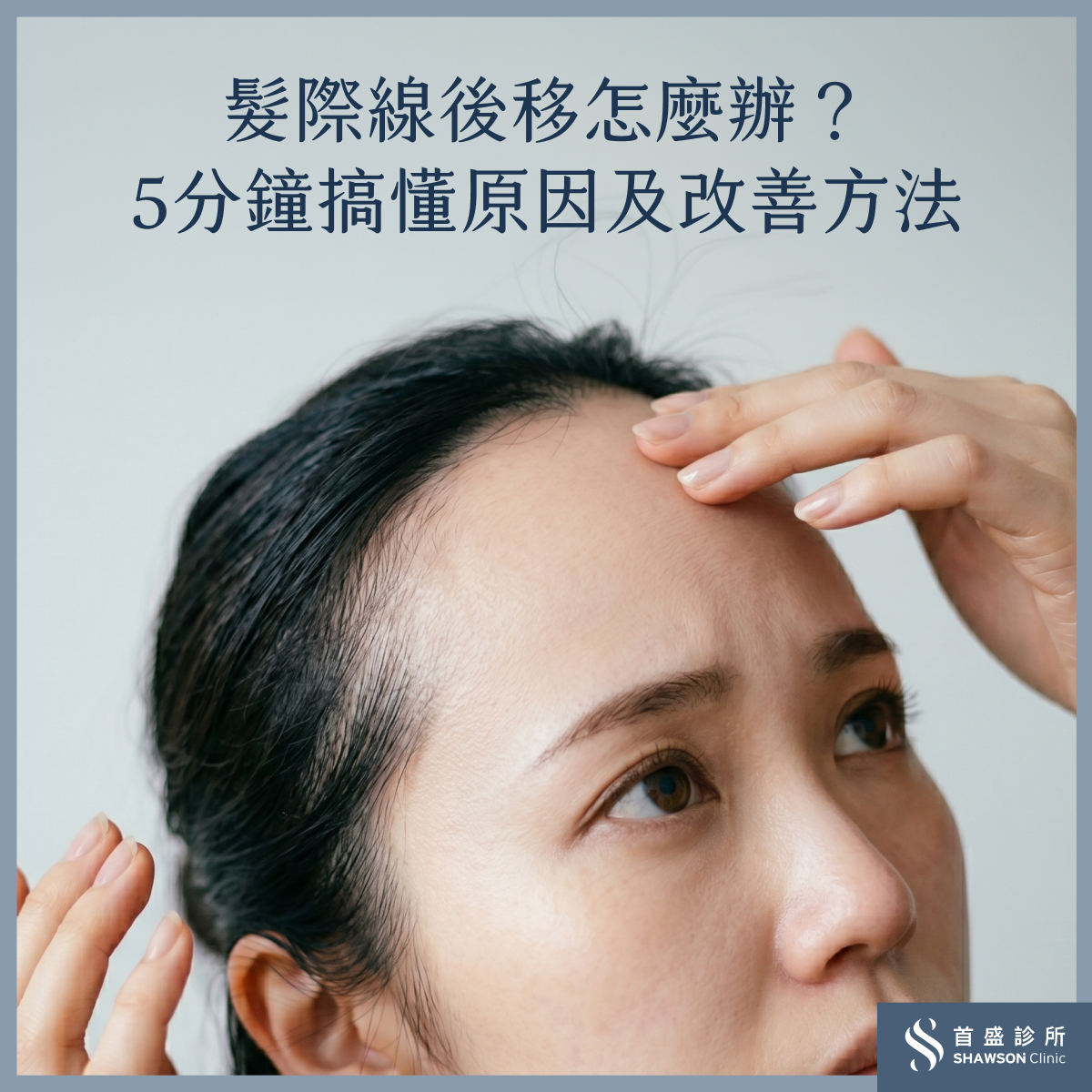 髮際線後移怎麼辦