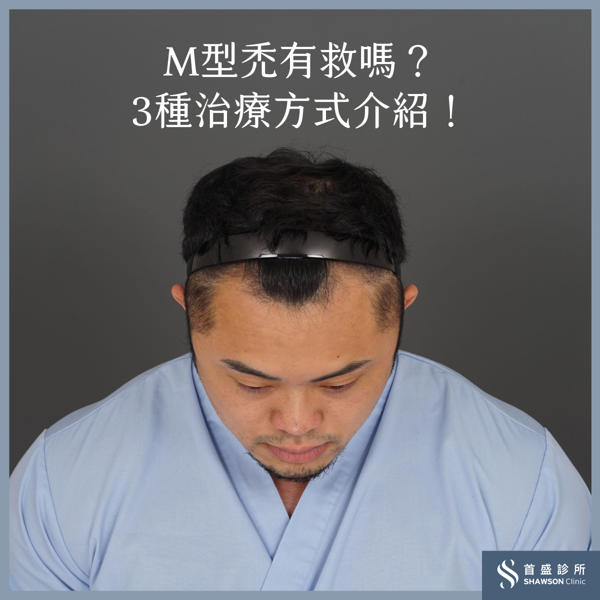 熱狗王M型禿植髮