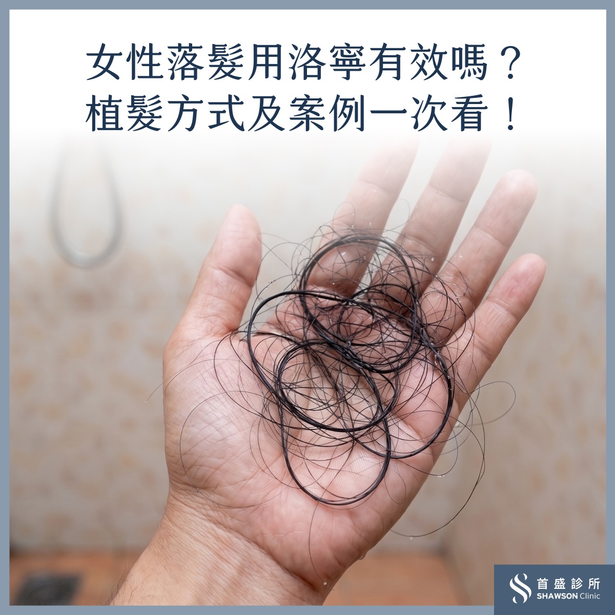 女性植髮方式為何?女性植髮費用多少