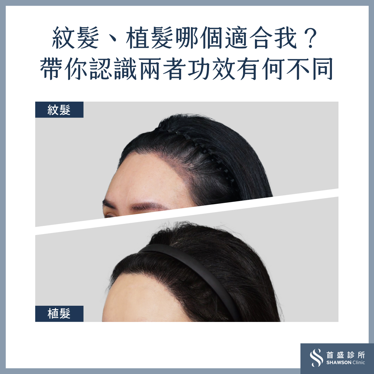 我該做紋髮還是植髮好