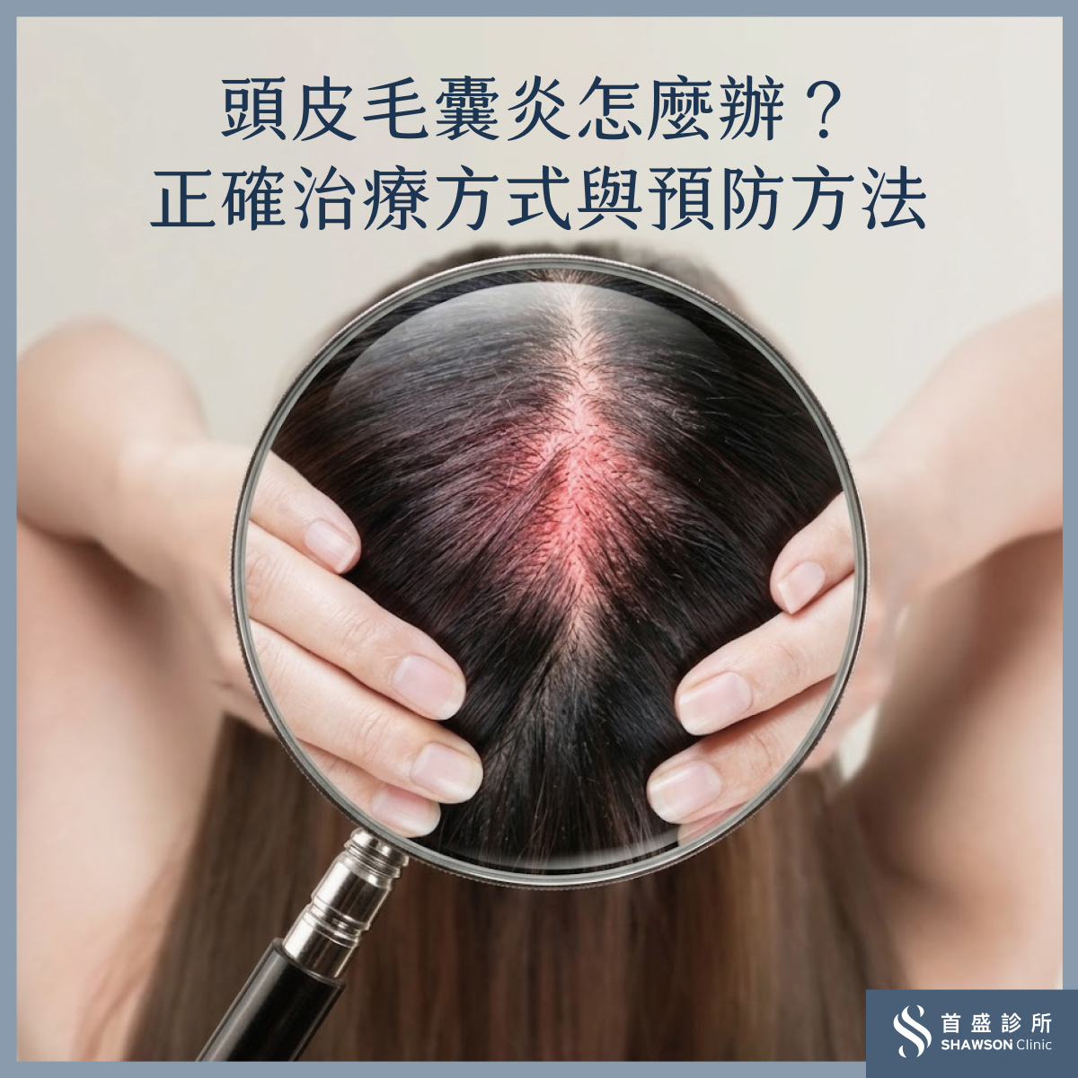 頭皮毛囊炎