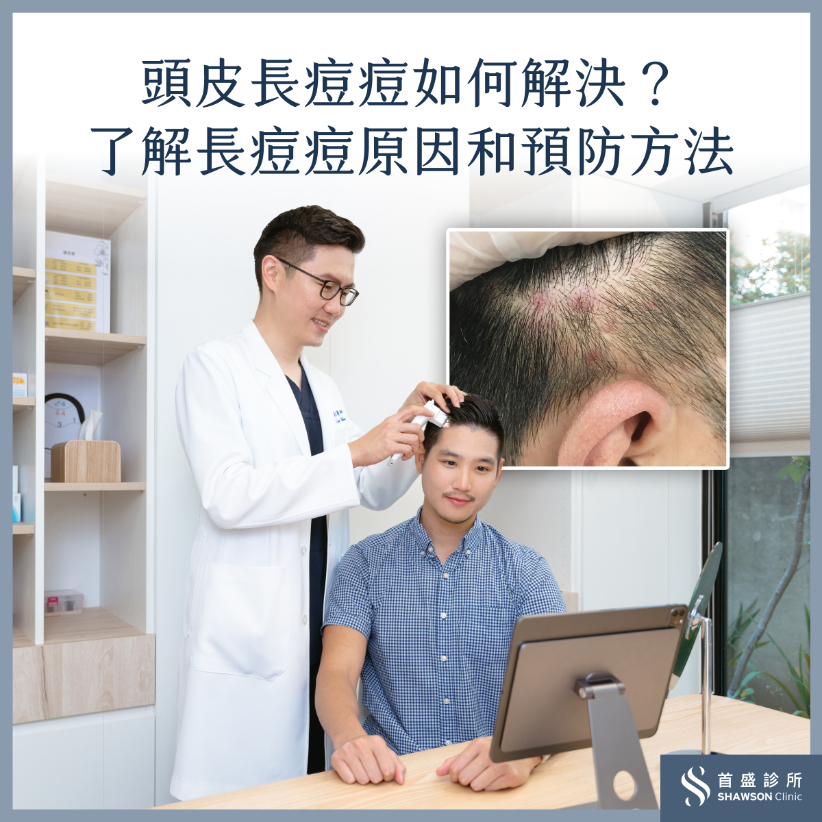 頭皮長痘痘困擾如何解決?