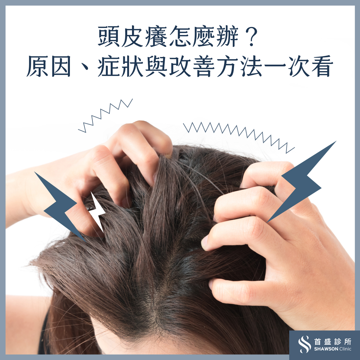 頭皮癢怎麼辦?頭皮癢會傳染嗎?