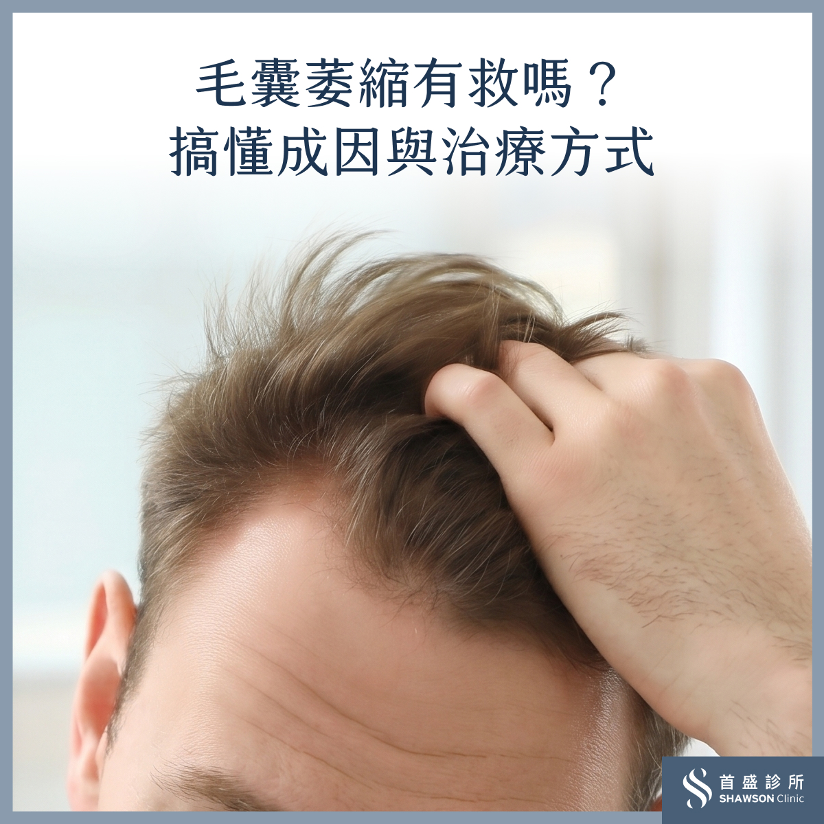 毛囊萎縮有救嗎?毛囊萎縮症狀、原因、治療方式一次看