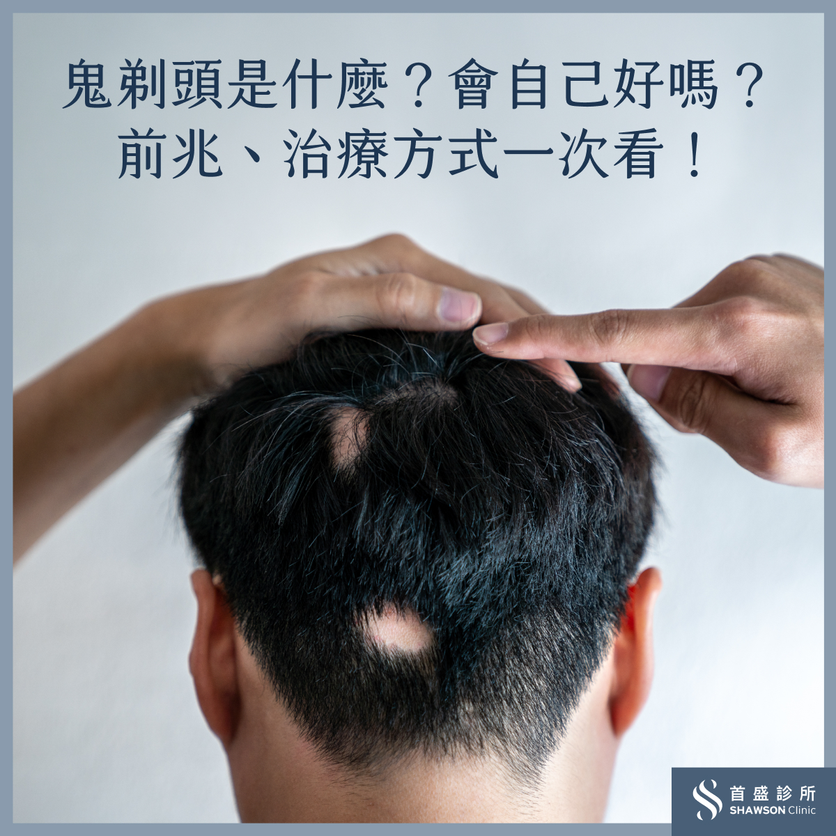 鬼剃頭是什麼?鬼剃頭前兆有哪些?