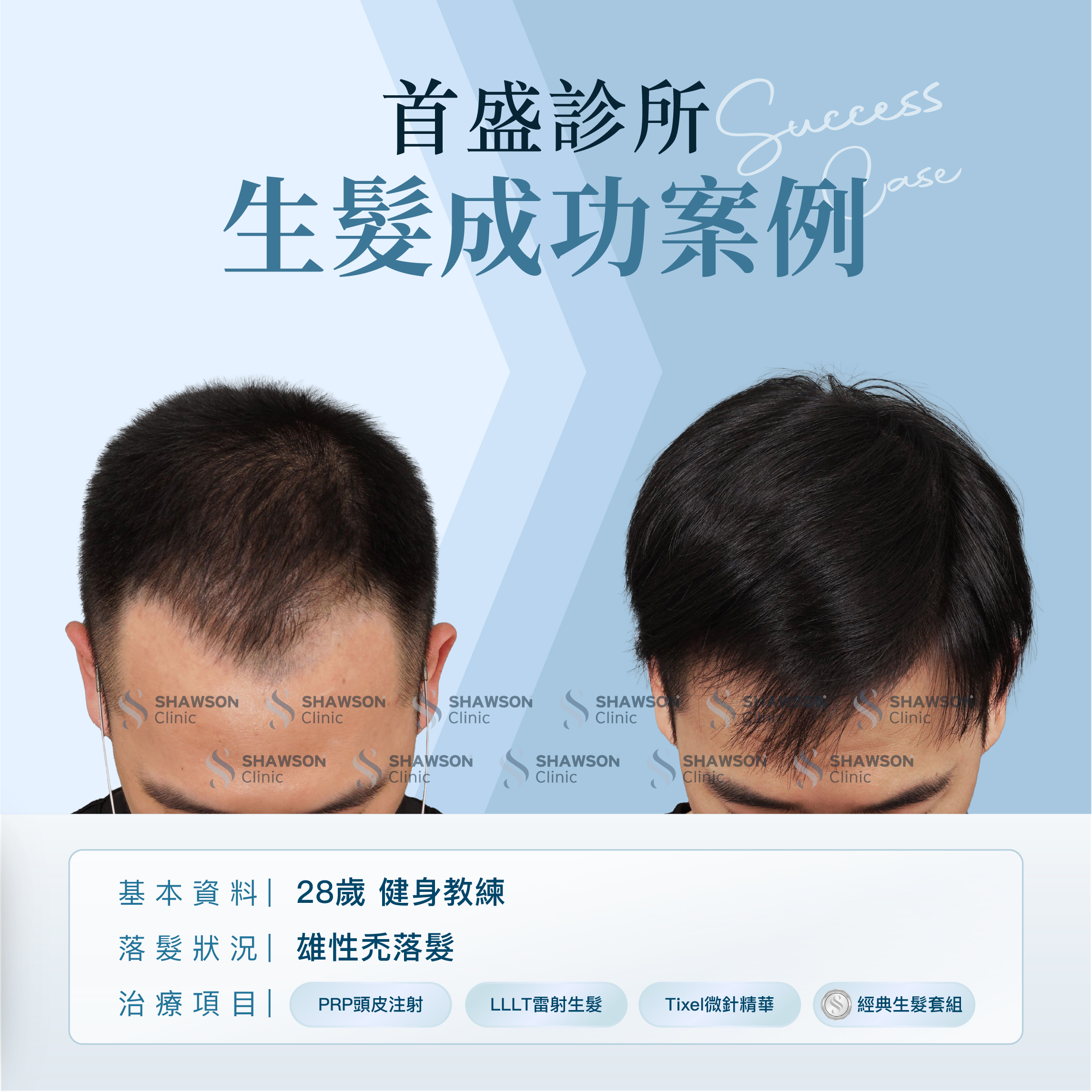 首盛診所生髮成功案例1，28歲健身教練​