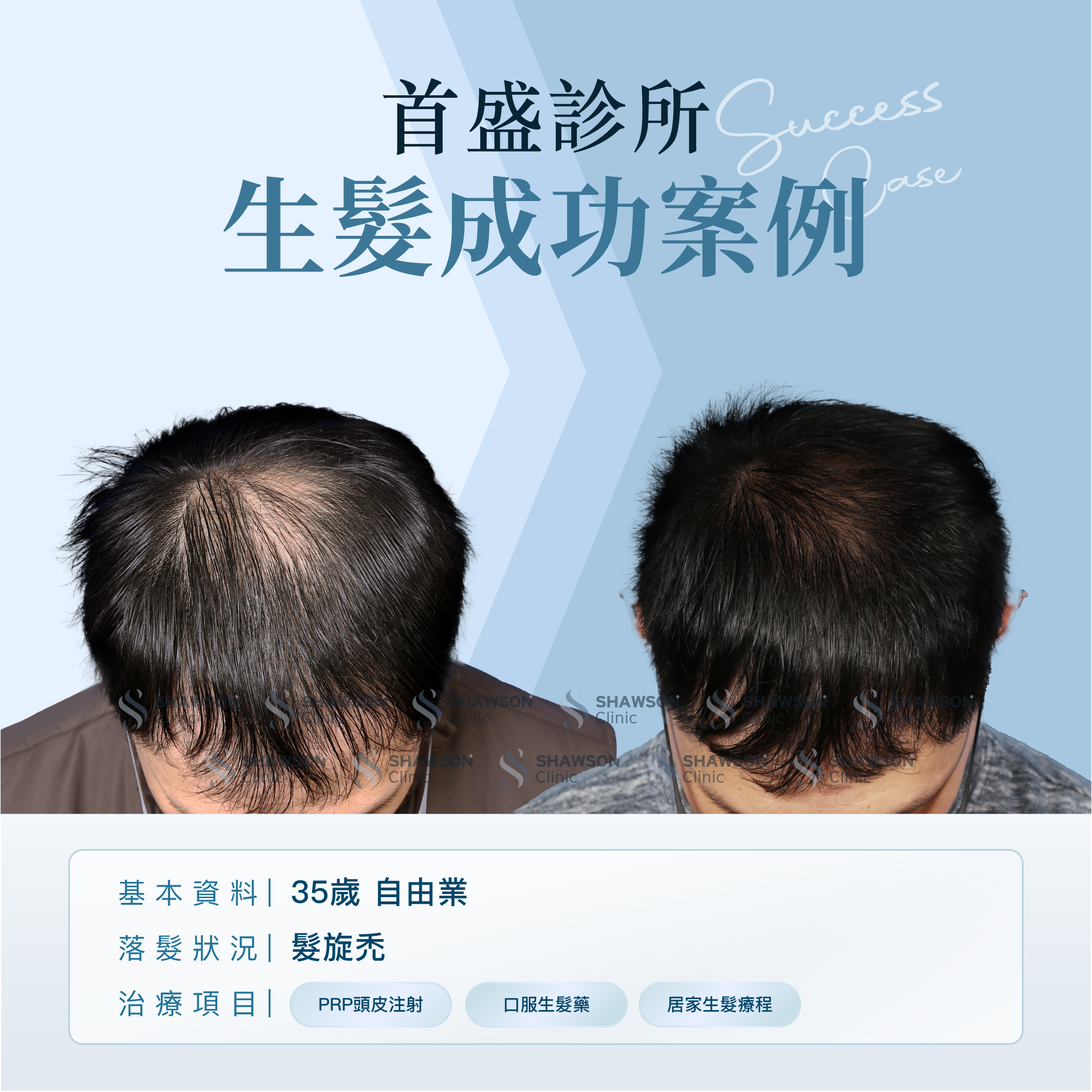 首盛診所生髮成功案例3，35歲自由業