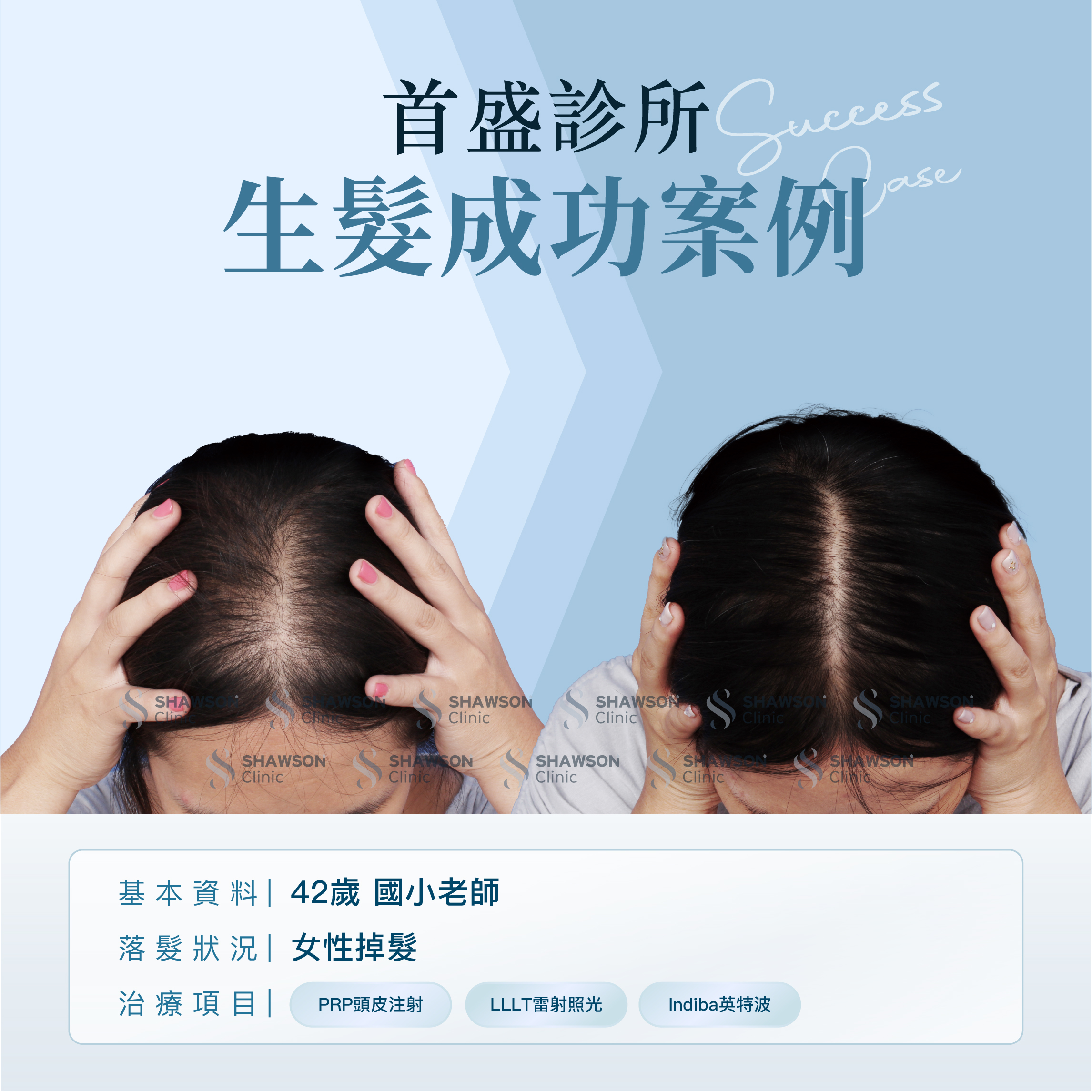 首盛診所生髮成功案例4，42歲國小老師