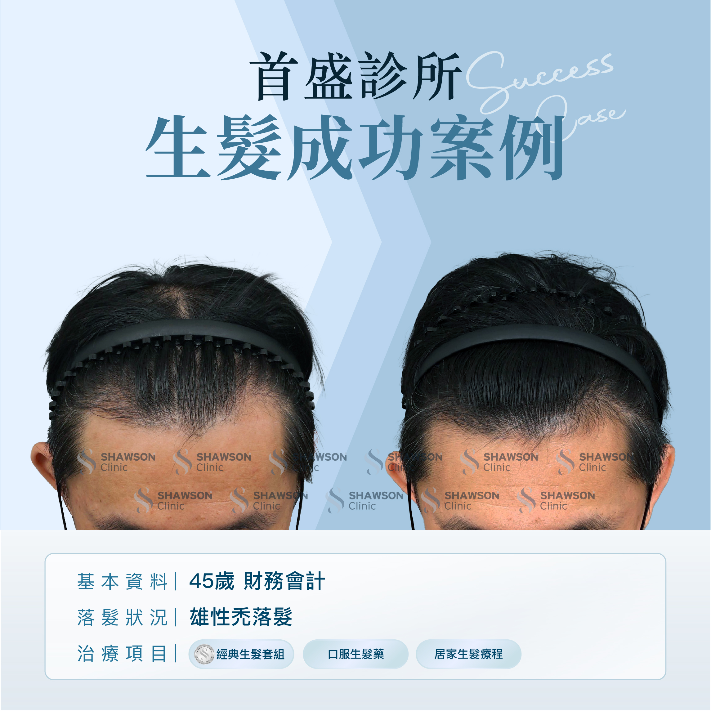 首盛診所生髮成功案例5，45歲財務會計