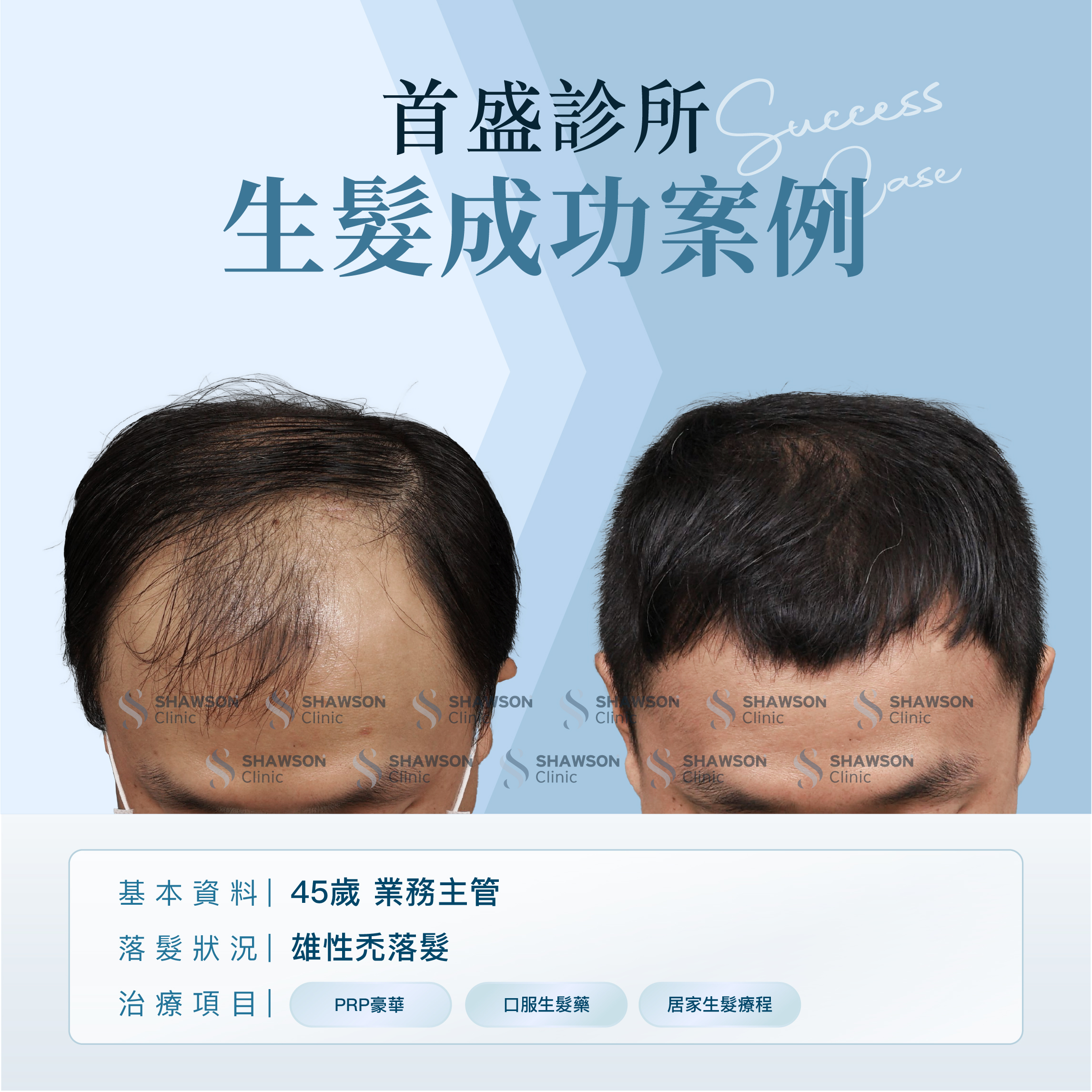 首盛診所生髮成功案例6，45歲業務主管