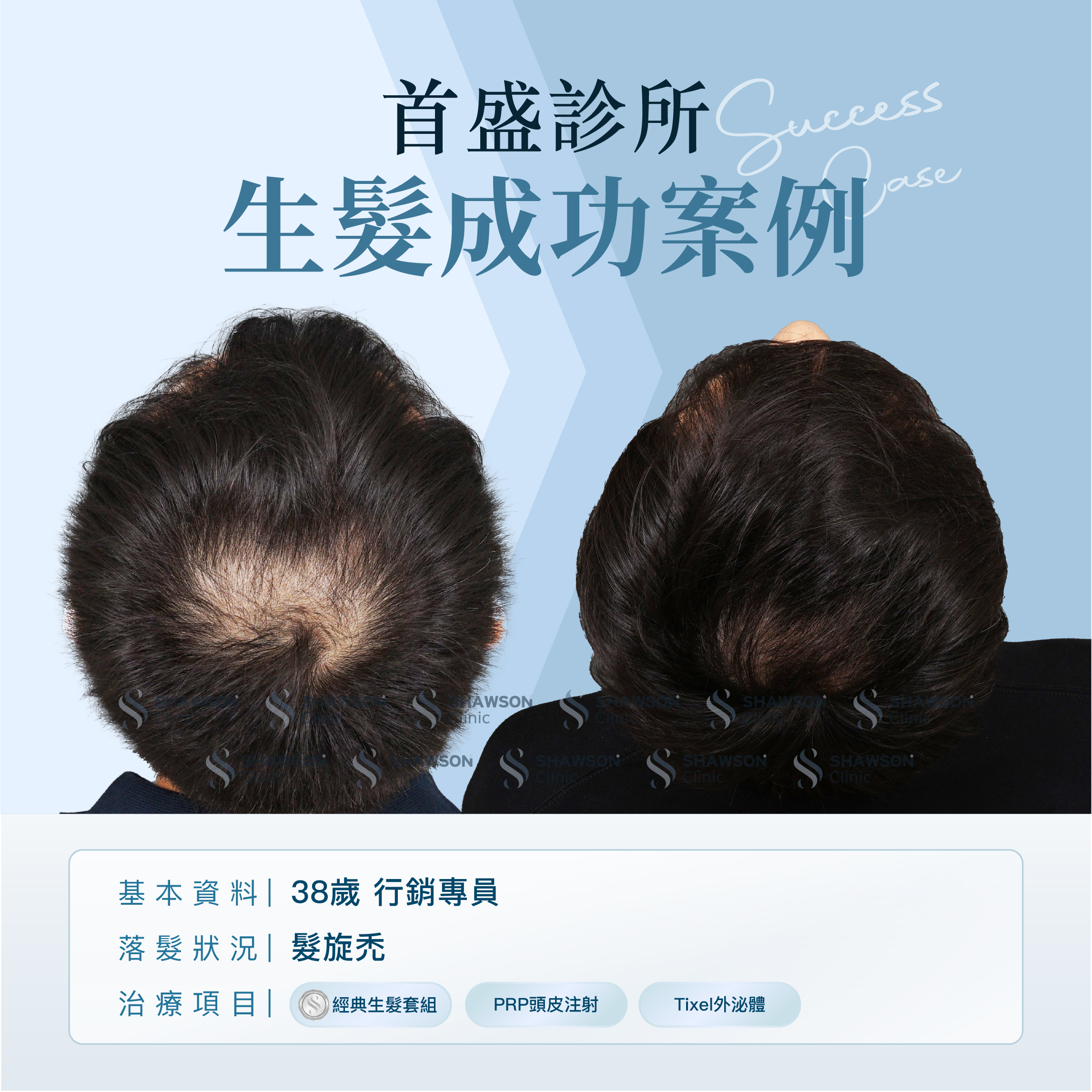 首盛診所生髮成功案例7，38歲行銷專員