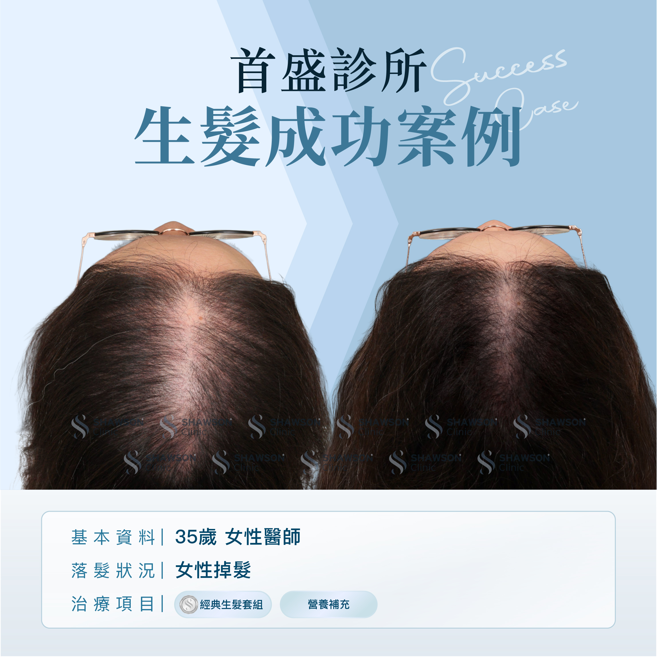 首盛診所生髮成功案例8，35歲女性醫師