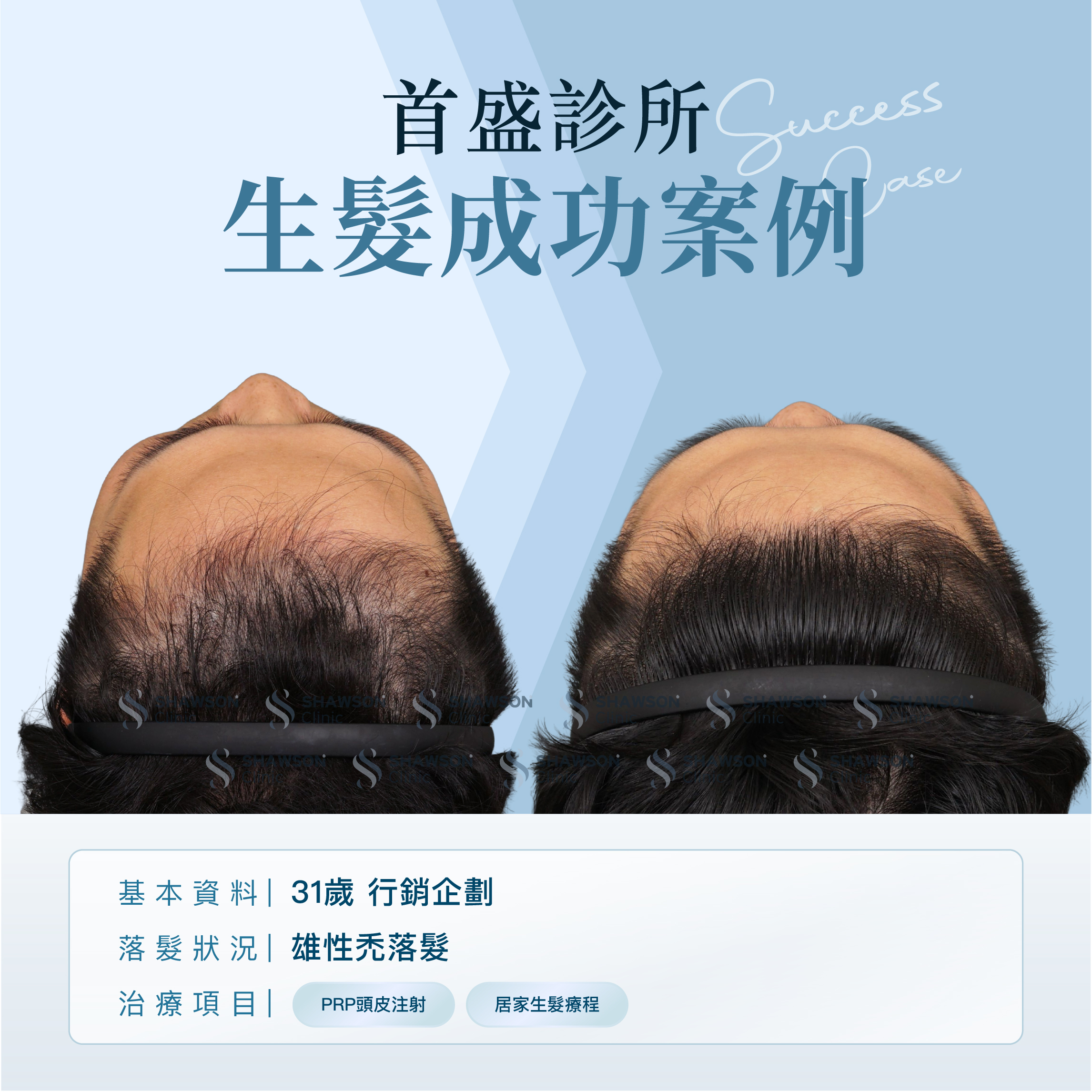 首盛診所生髮成功案例9，31歲行銷企劃