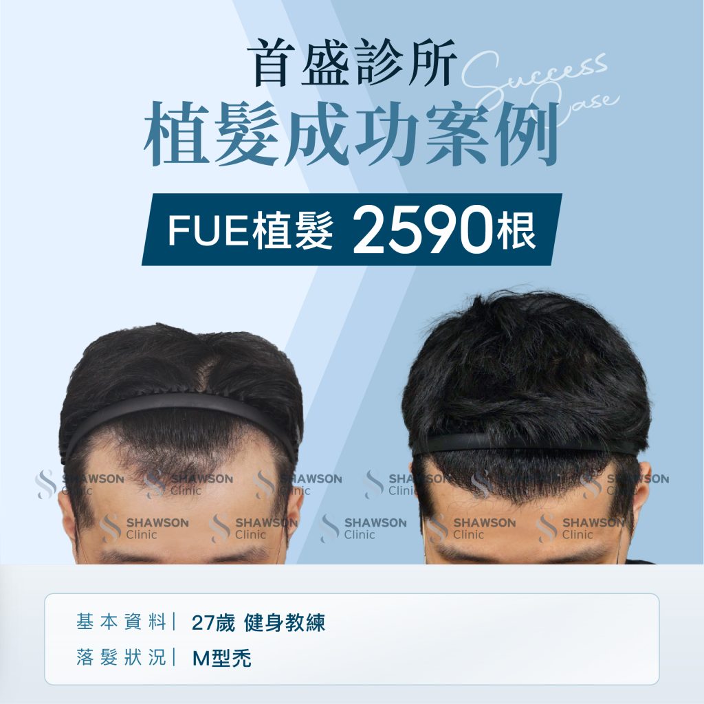 首盛診所植髮成功案例1，FUE植髮 2590根