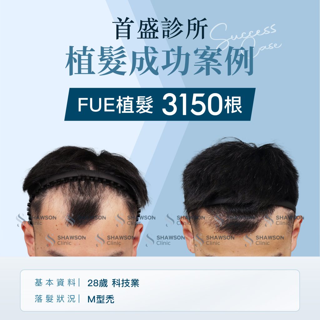 首盛診所植髮成功案例2，FUE植髮 3150 根