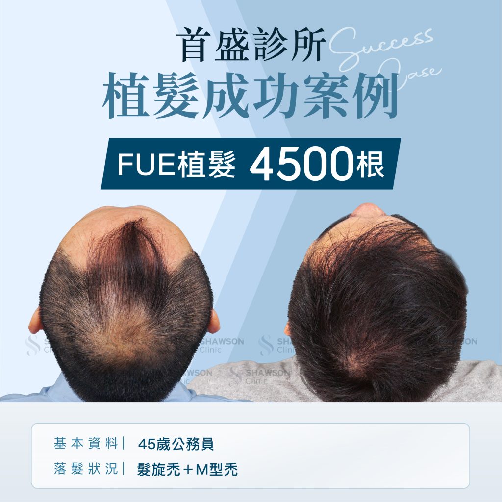 首盛診所植髮成功案例4，FUE植髮4500根