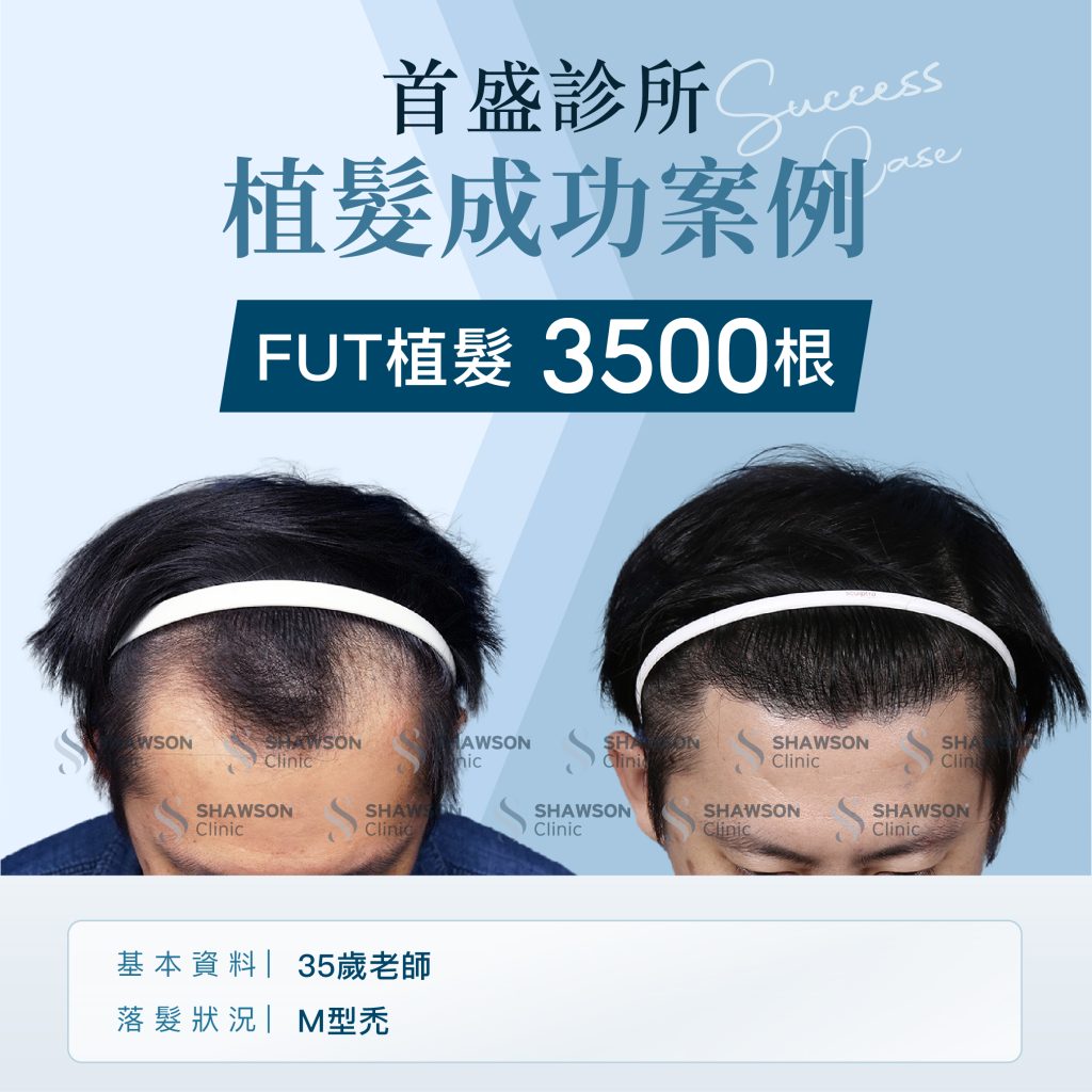 首盛診所植髮成功案例6，FUT植髮3500根