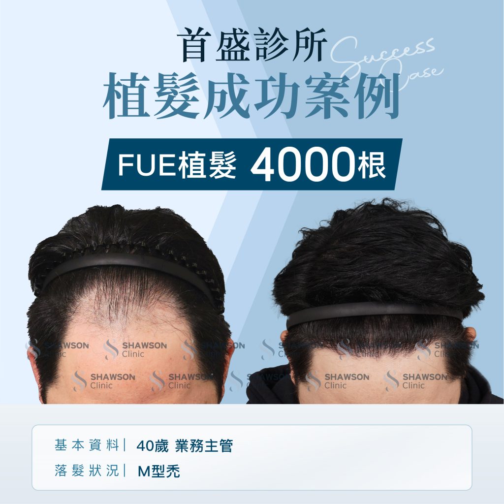 首盛診所植髮成功案例5，FUE植髮4000根