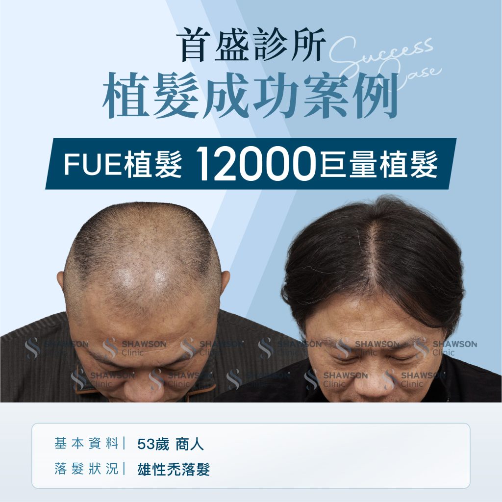 首盛診所植髮成功案例7，FUE巨量植髮12000根