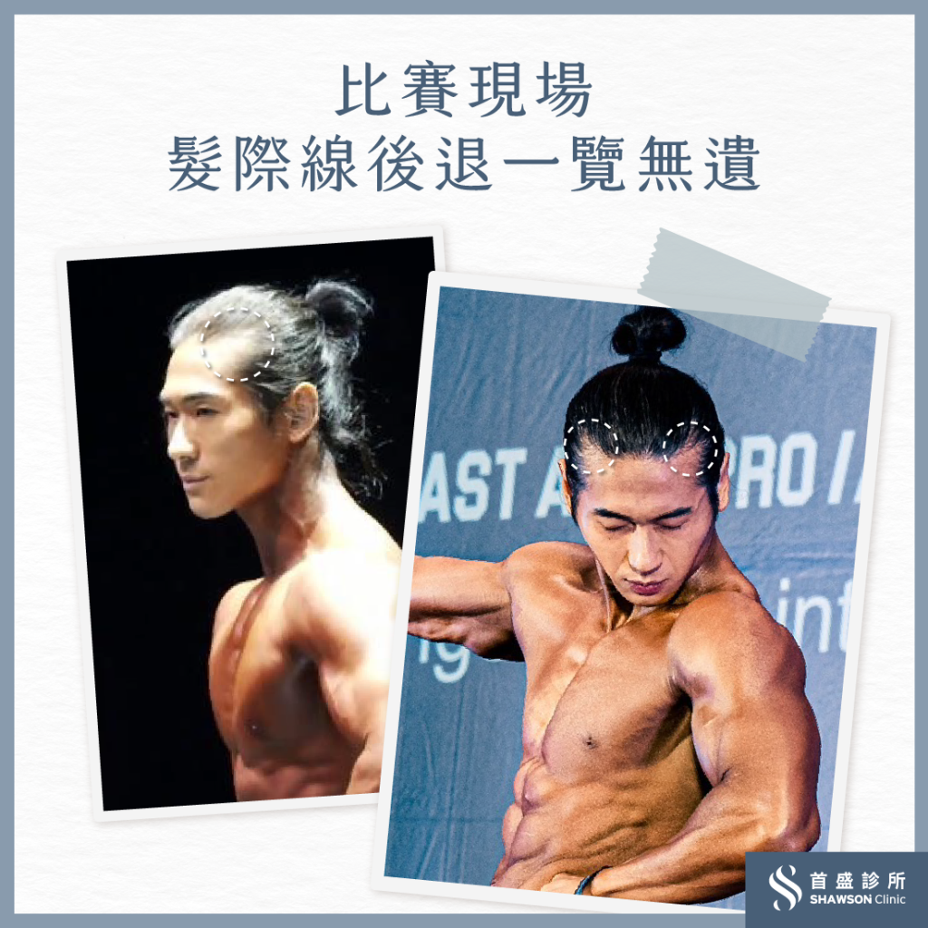 健美選手Ting的心酸：舞台強光，讓髮際線後退一覽無遺​
