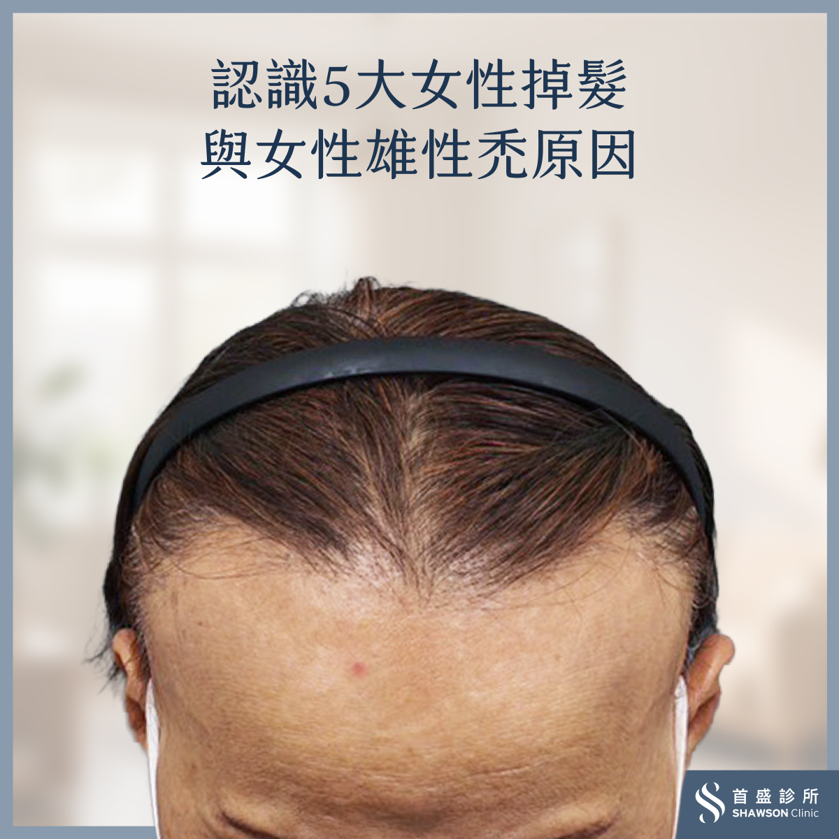 女性雄性禿原因