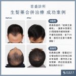 柔沛、適尿通、波斯卡、新髮靈如何選擇？禿頭生髮藥功效、副 …