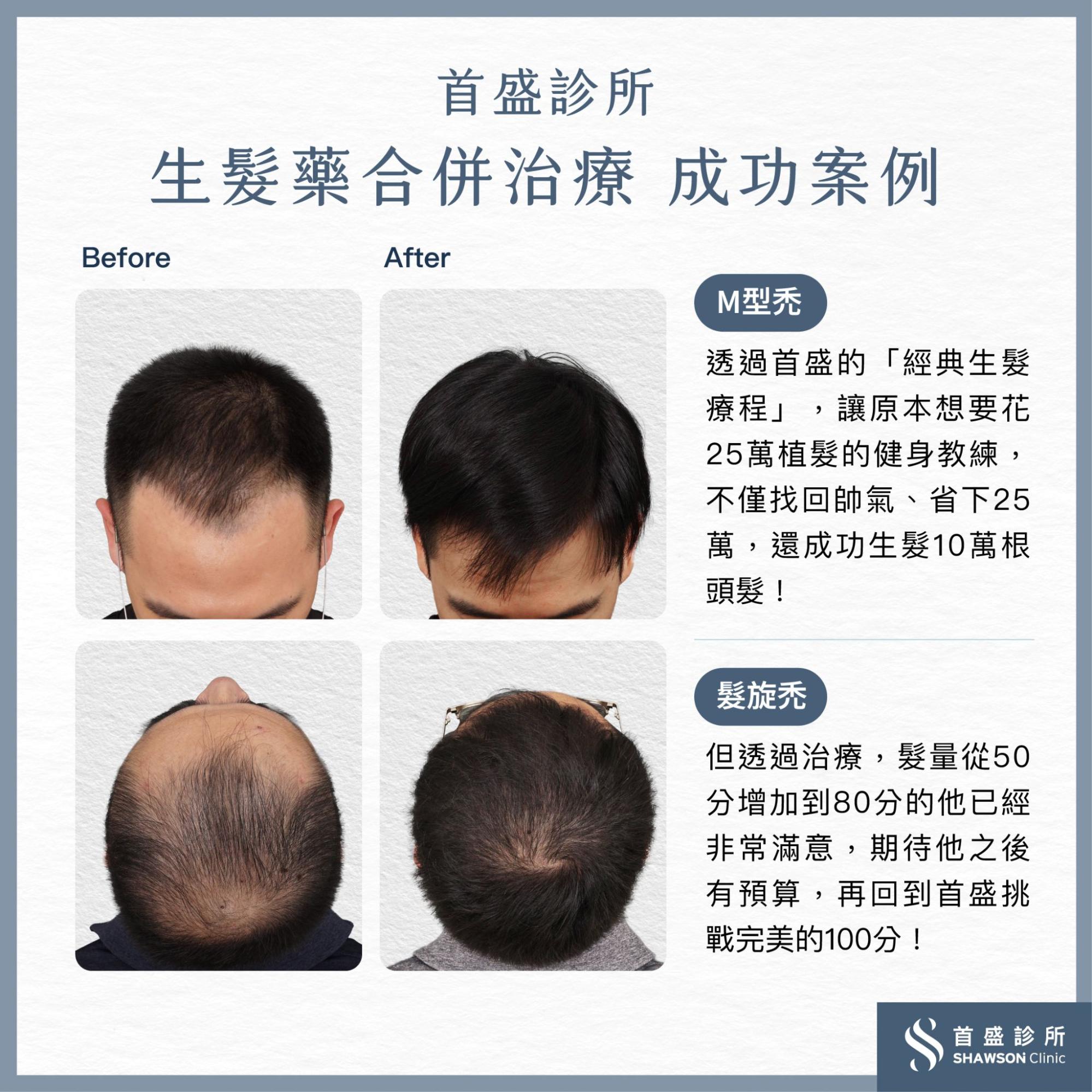 生髮藥成功案例