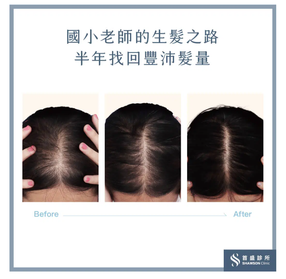 頭髮分線明顯女性案例