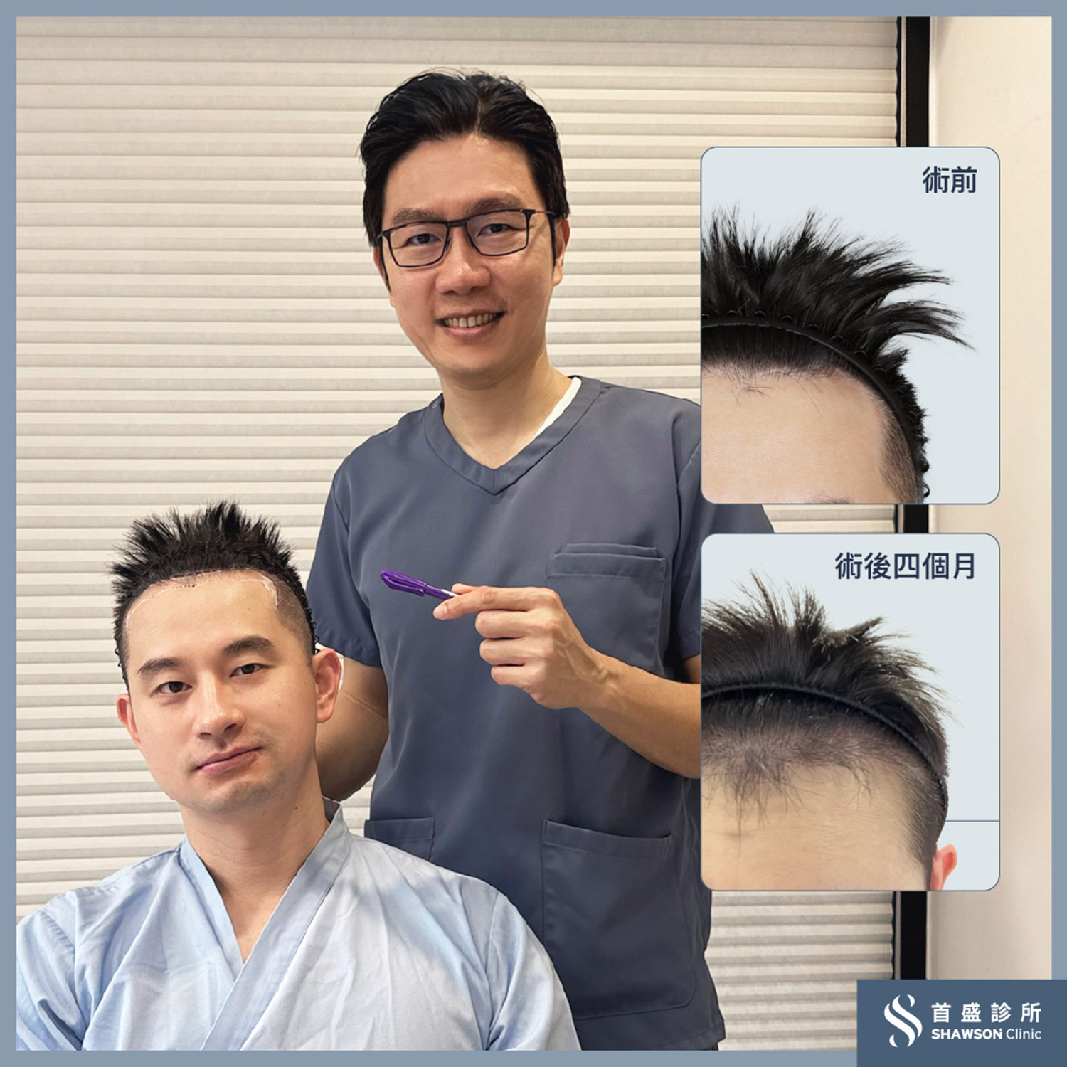 植髮120天後成果揭曉,炸毛圖片馬上看!