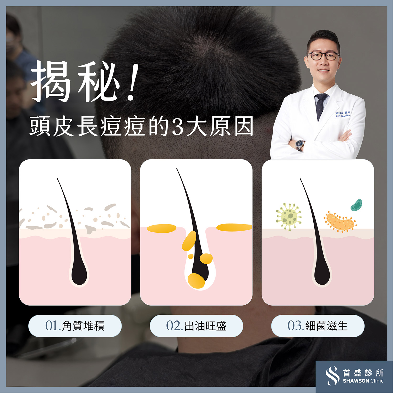 皮膚專科醫師：頭皮長痘痘的3大原因