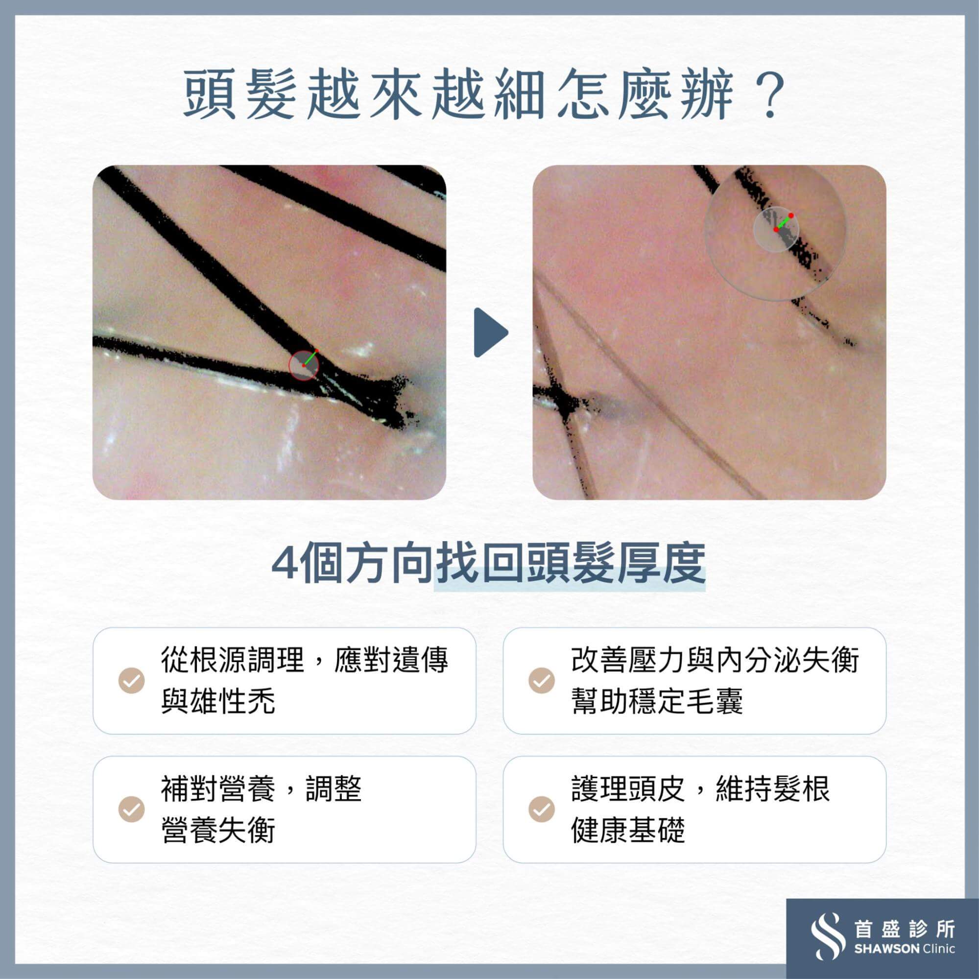 使用寬齒梳、睡前輕輕按摩頭皮都可幫助毛囊健康