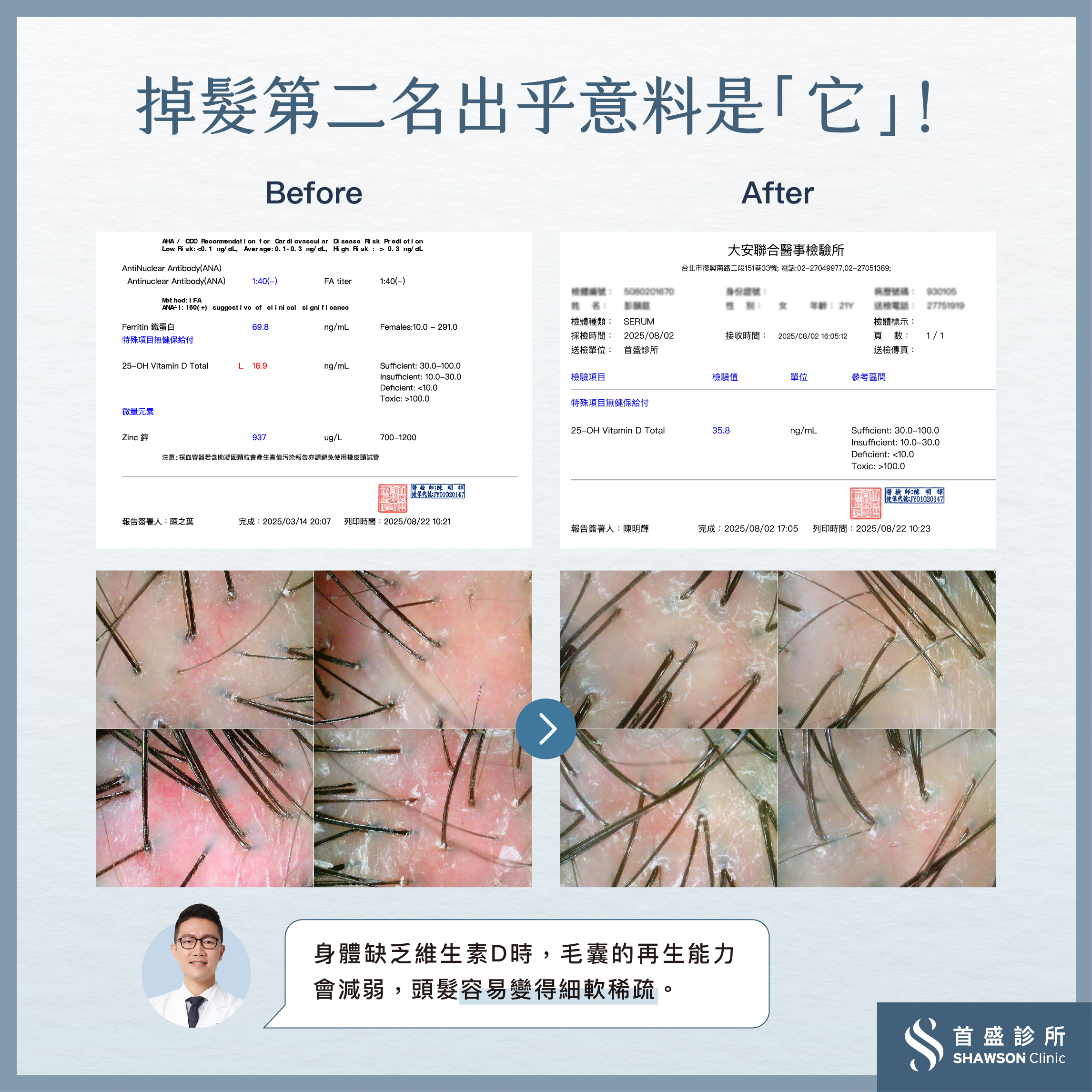 掉髮第二名出乎意料是它！