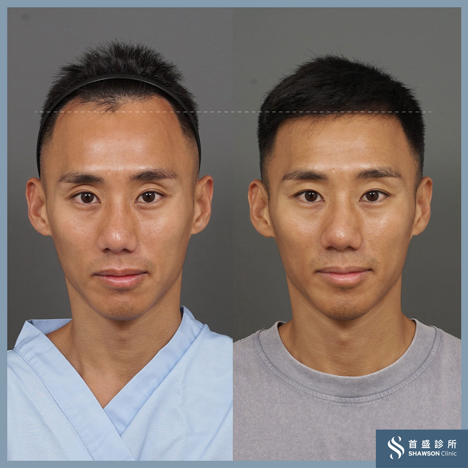 海外植髮4大風險！香港人Jeffrey來台植髮全攻略