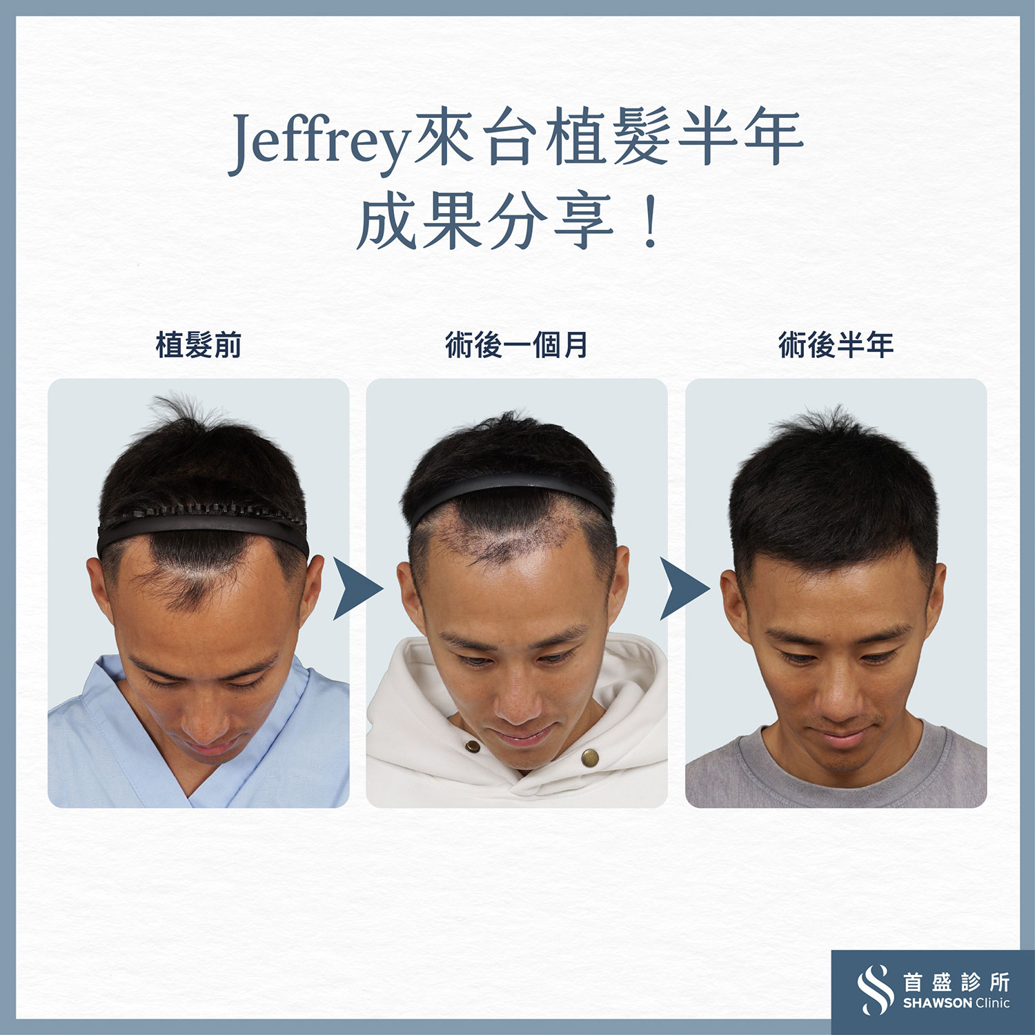 Jeffrey海外植髮半年成果分享！2600根大成功