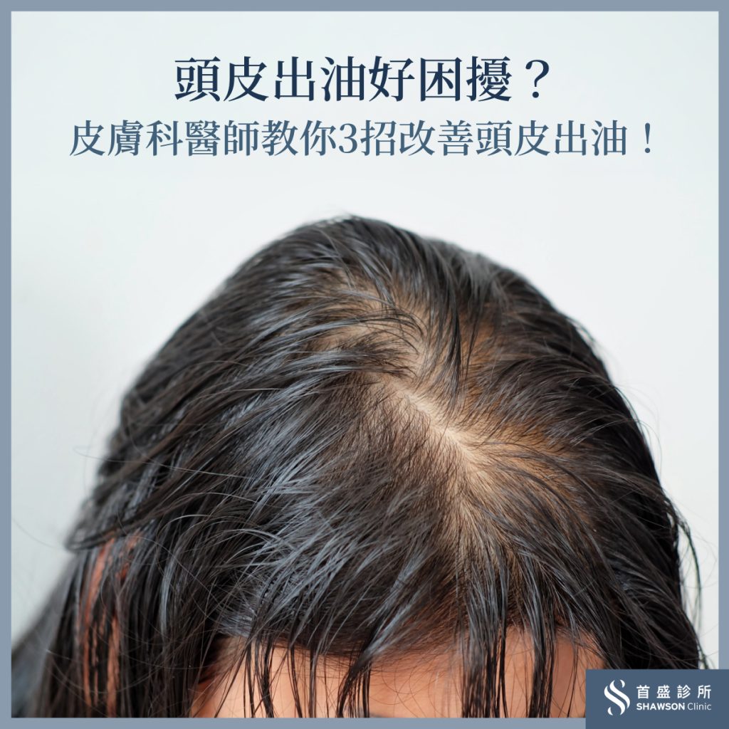 頭皮出油怎麼辦?如何改善頭皮出油?