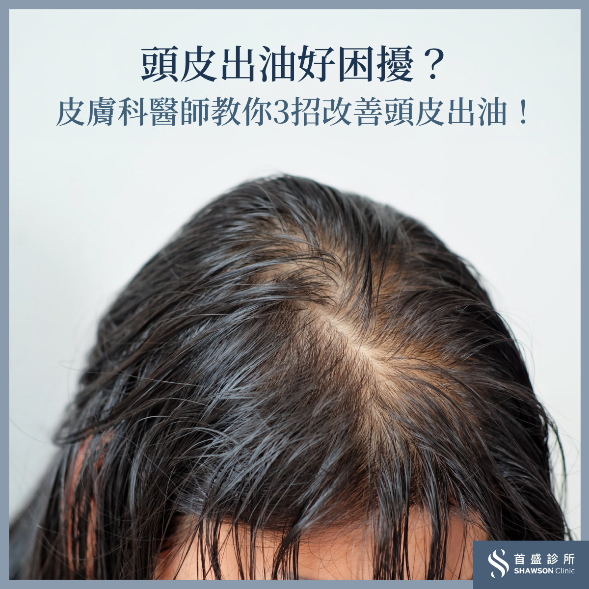 頭皮出油怎麼辦?如何改善頭皮出油?