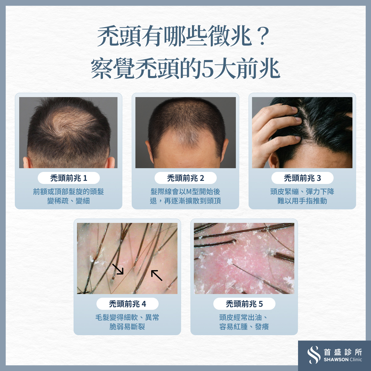 禿頭的5個前兆有哪些