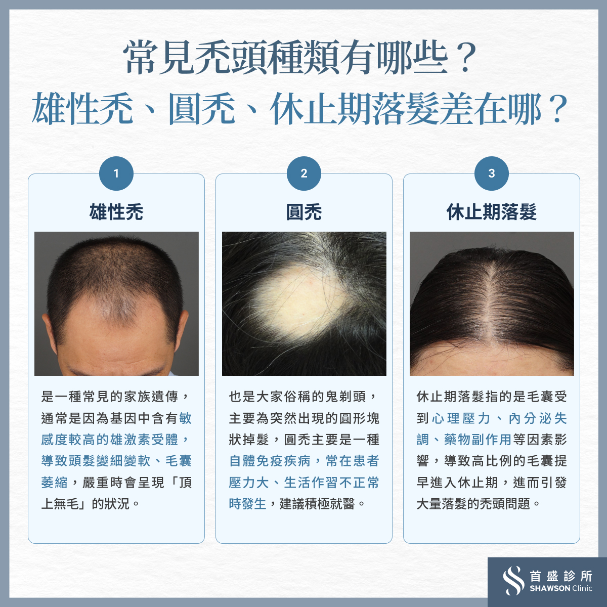 禿頭的5個種類