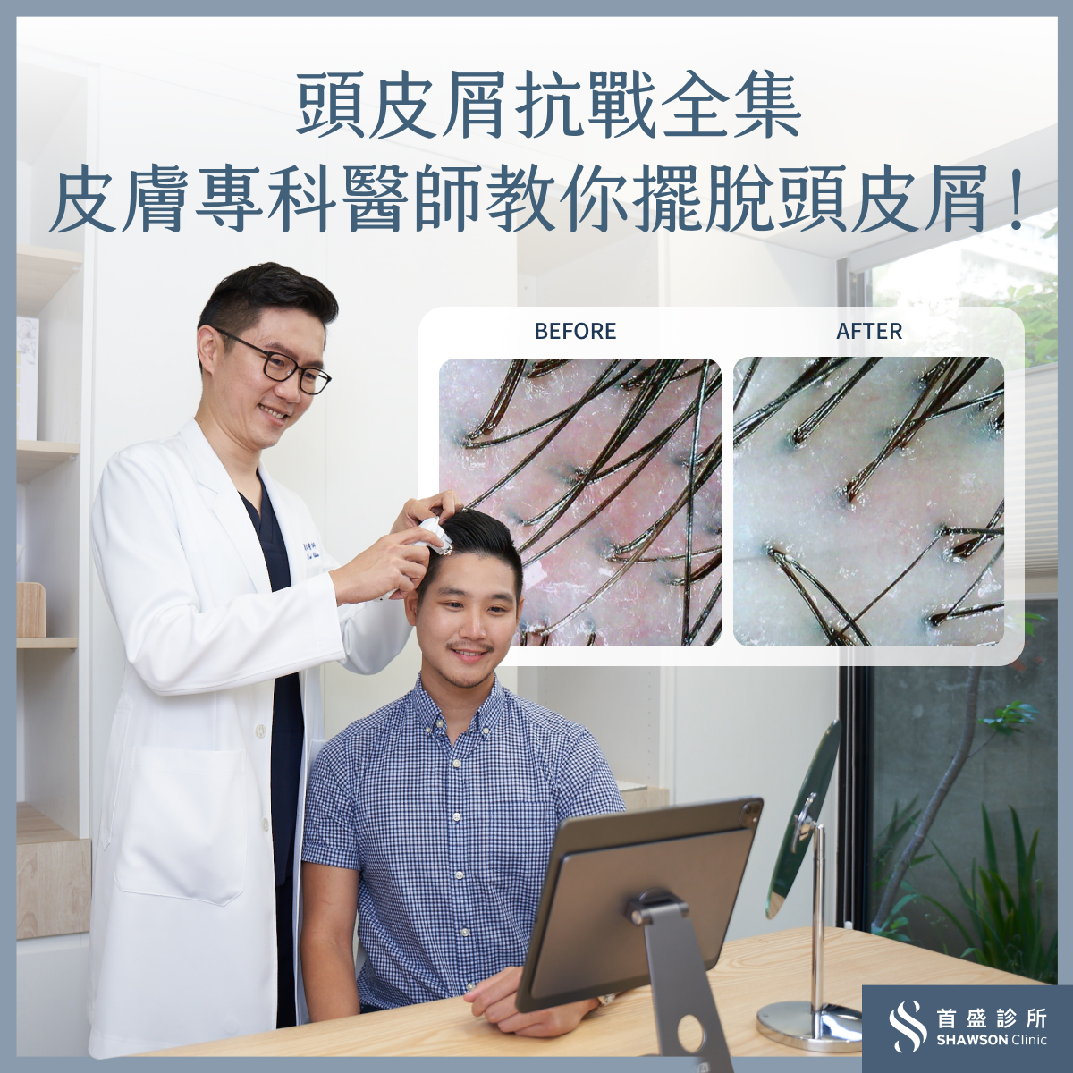 頭皮屑改善全集:解析成因、挑對洗髮精