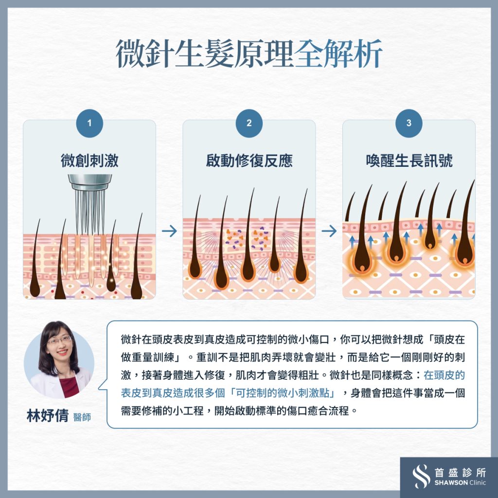 微針生髮的機制原理一次看懂