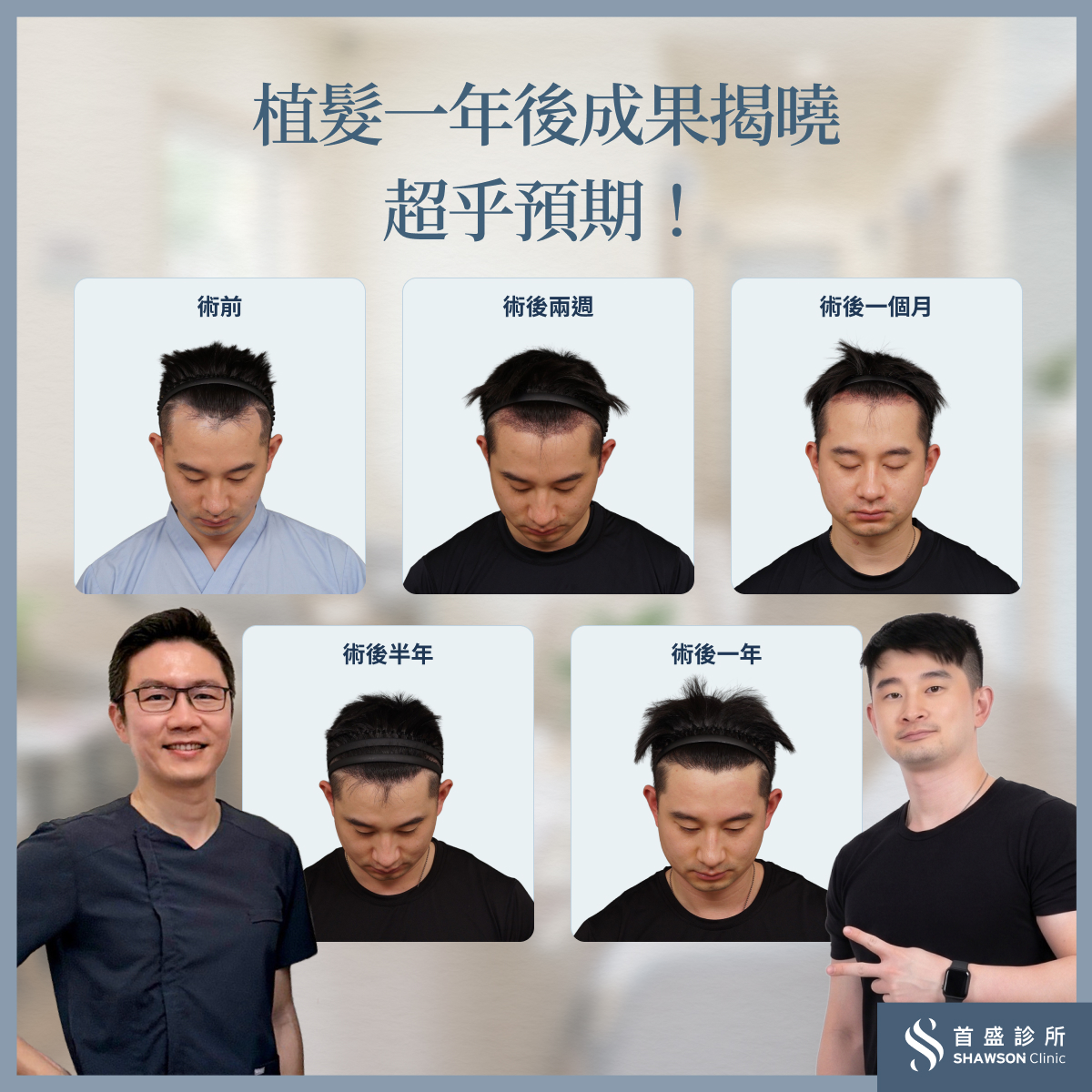 植髮一年後成果揭曉,效果超乎預期