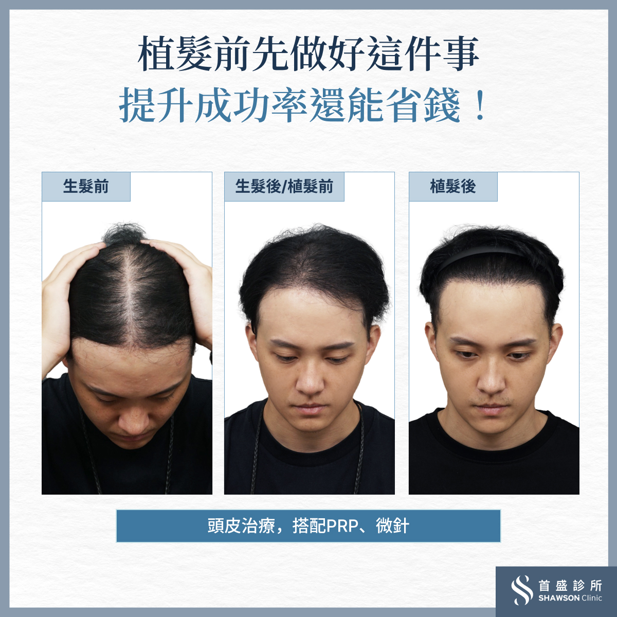 首盛診所生髮案例傑恩